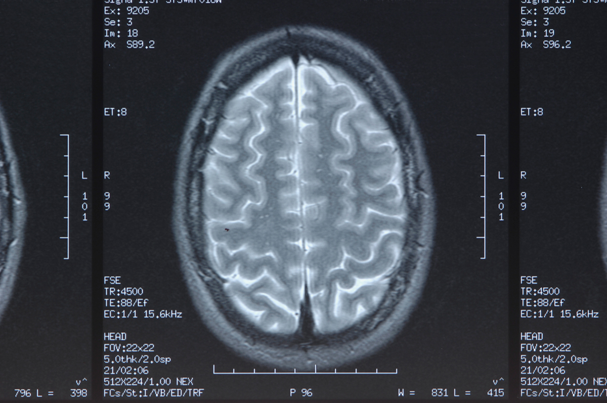 Radiografía del cerebro